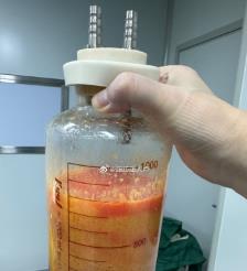 甘孜水动力吸脂手术要做多久？